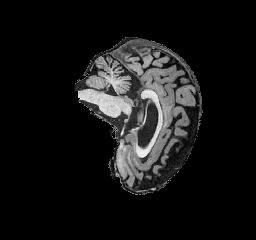Alzheimer's Classification screenshot